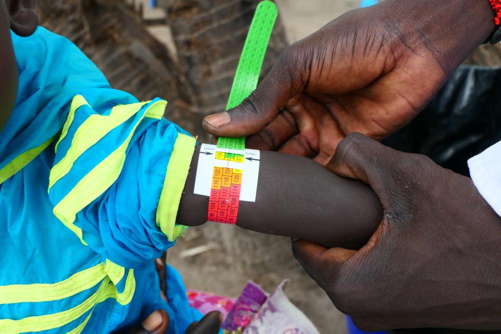 MSF medical staff screens children under five years old for malnutrition. Yellow colour in the MUAC tape indicates the child is at risk of acute malnutrition.