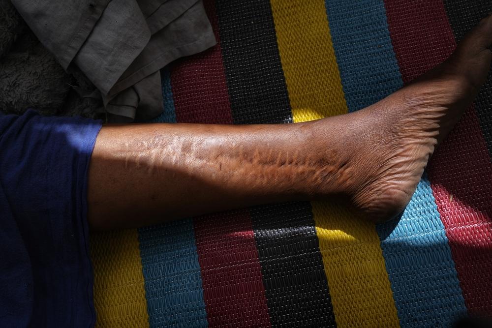The scar of a patient whose leg was hit by a bullet during crossfire and battle.