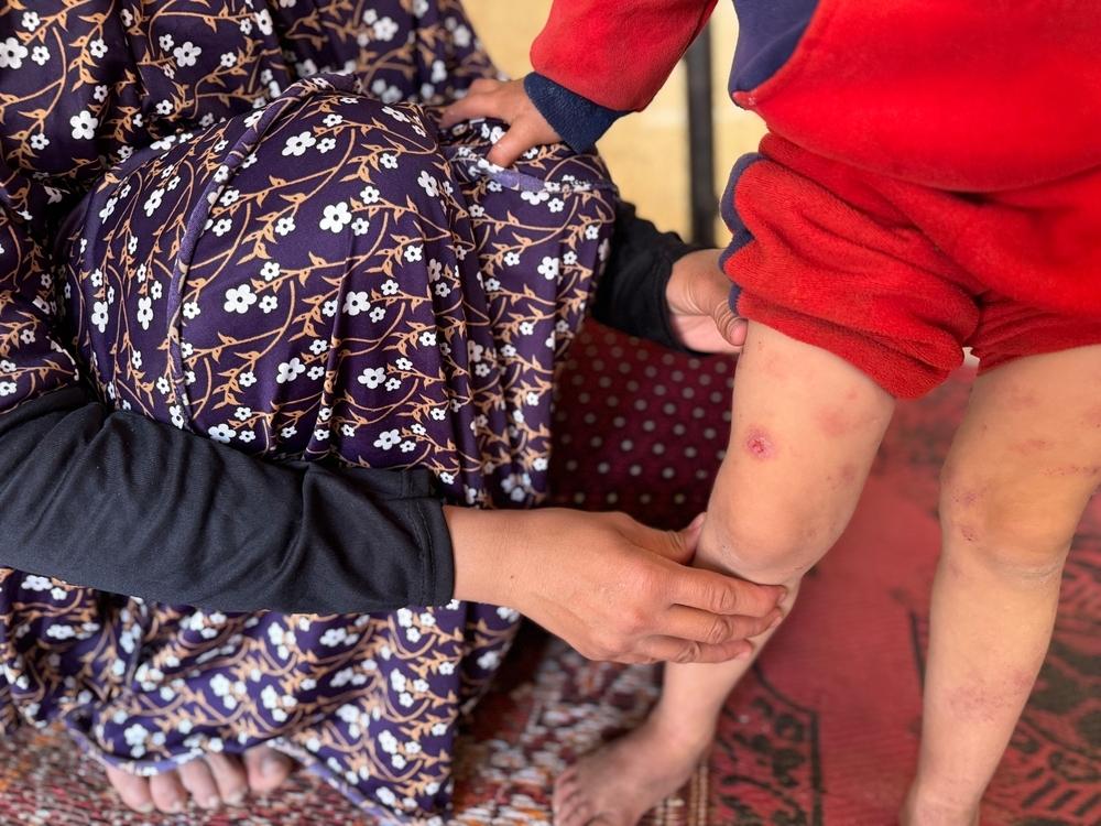 Palestinian mother shows the skin condition of her little child due to the lack of hygiene and clean water