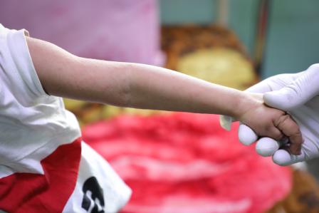 Yemen: Not just numbers – an alarming rise of measles in the country